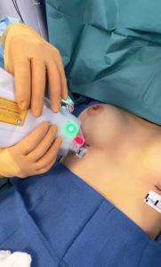 Utilisation Urgo Touch à Ajaccio, cicatrice implant mammaire